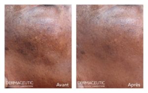 DERMACEUTIC-MELA-PEEL-7-1024x643