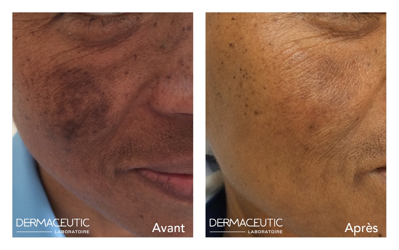 DERMACEUTIC-MELA-PEEL