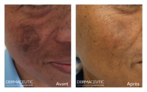 DERMACEUTIC-MELA-PEEL