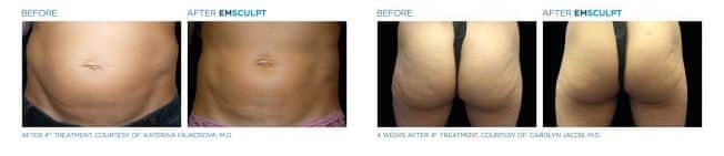 emsculpt-paris-arthestic