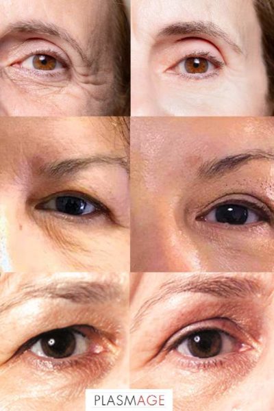 avant-apres-blepharoplastie-medicale-arthestic-paris