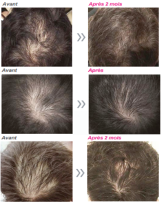 avant-après hair filler arthestic paris