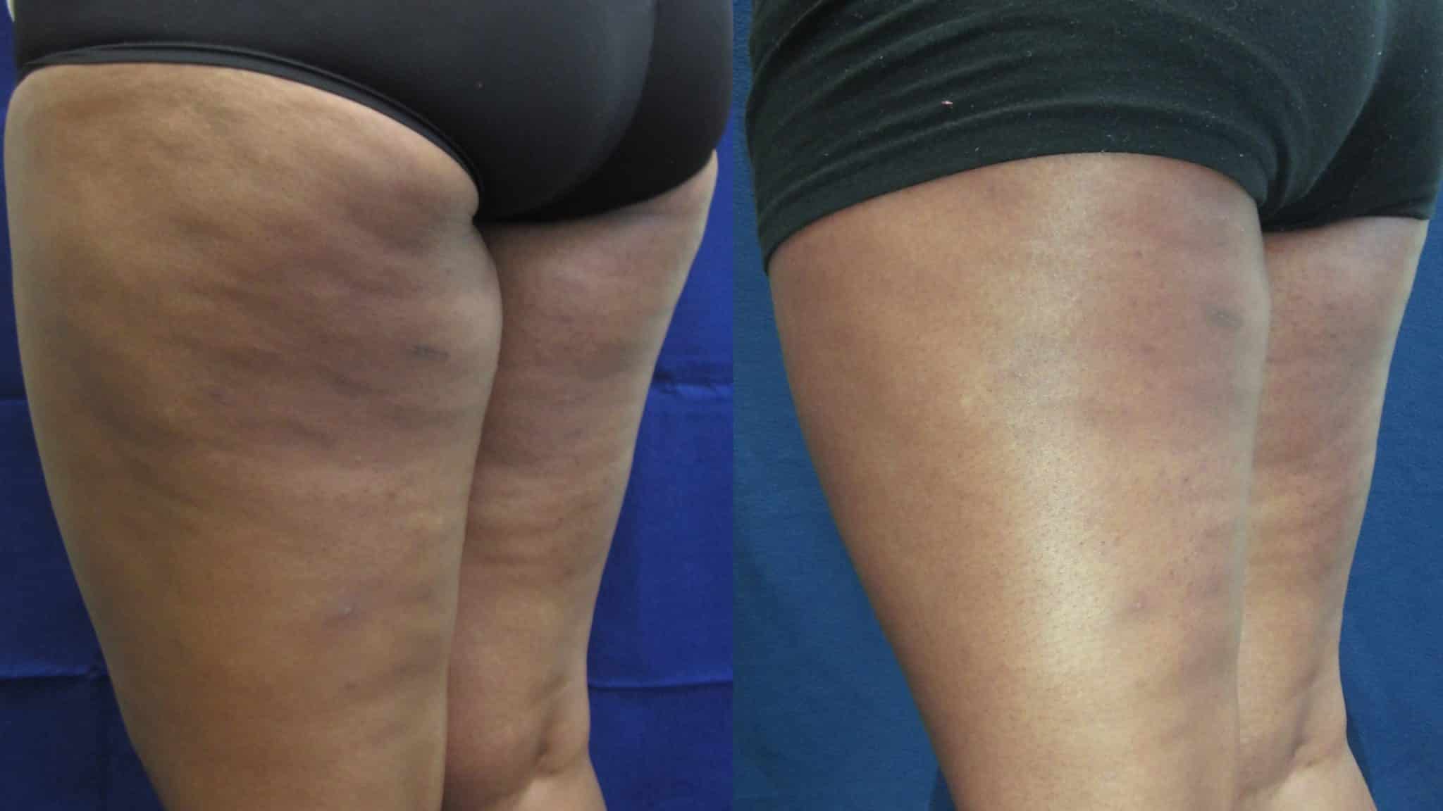 traitement cellulite fibreuse peau orange capitons paris