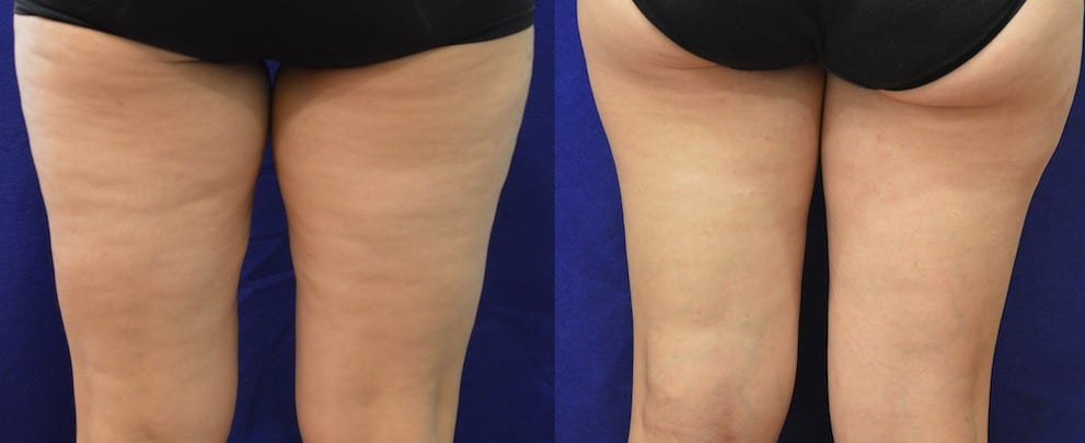 traitement cellulite capitons peau d'orange arthestic paris