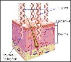 laser-co2-peau-arthestic-medecine-esthetique-paris