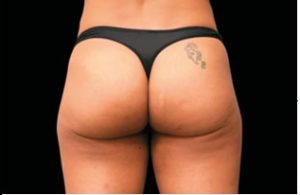 Emsculpt Fesses, Avoir De Belles Fesses, Avoir Des Fesses Plus Rondes, Muscler Ses Fesses