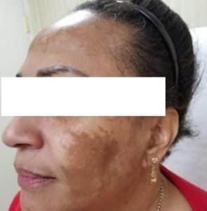 Peeling Pour Taches, Peeling Peau Foncées, Peeling Peaux Noires, Peeling Melasma