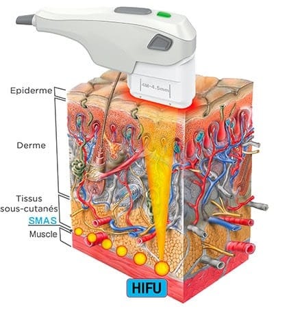 comment marche ultrasons peau, quelle profondeur ultrasons peau,