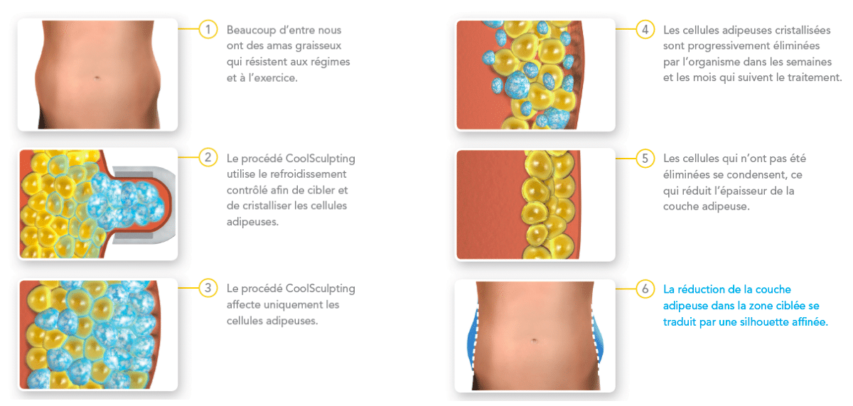 cryolipolyse par coolsculpting, détruire les bourrelets graisseux par coolsculpting,