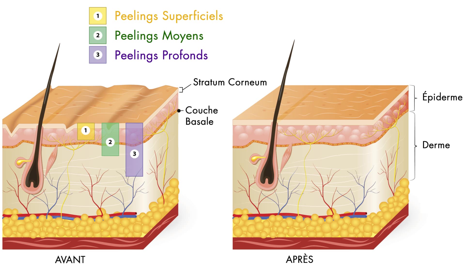 quel type de peeling pour quel besoin, profondeur penetration selon le type de peeling