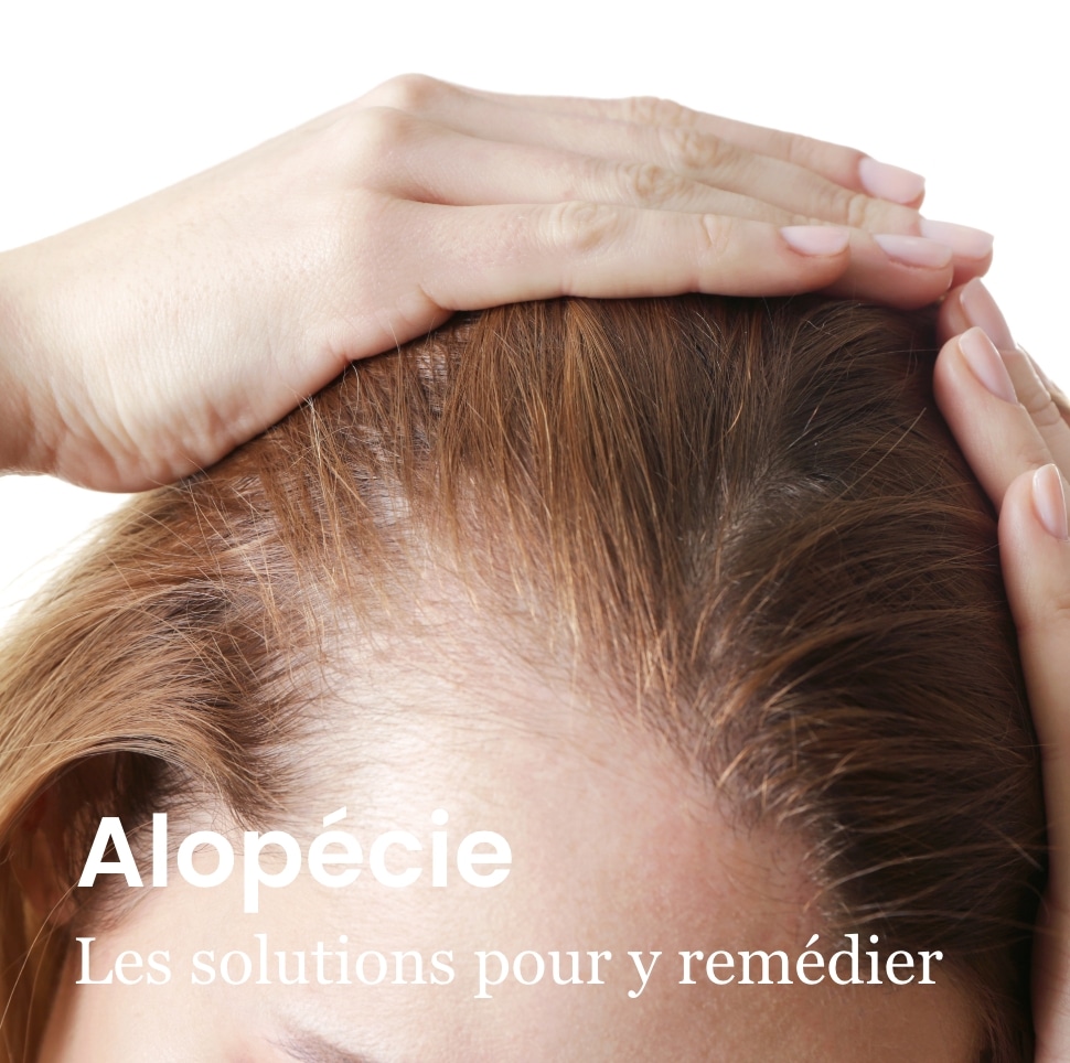 ALOPECIE SOLUTION ARTHESTIC PARISMEDECINE ESTHETIQUE
