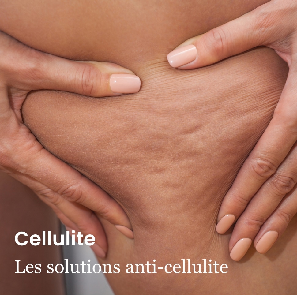 cellulite : traitements et solutions